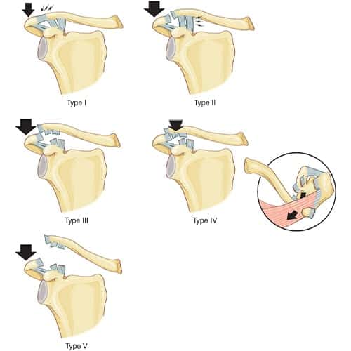 articulation acromio claviculaire douleur clinique jouvenet epaule chirurgien orthopediste specialistes epaule