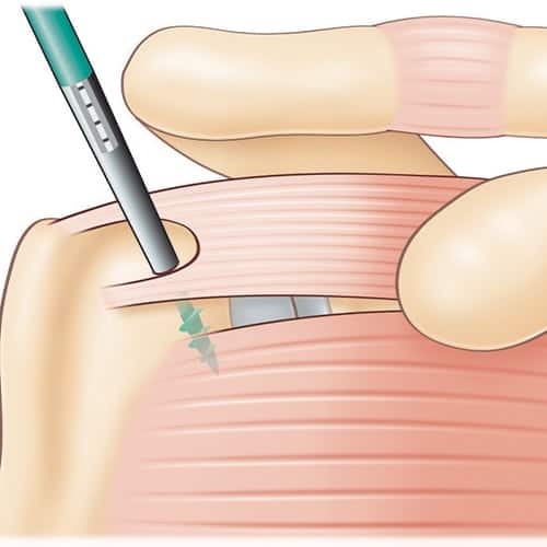 Acromion avec bec osseux bursite et tendinite clinique jouvenet epaule chirurgien orthopediste specialistes epaule