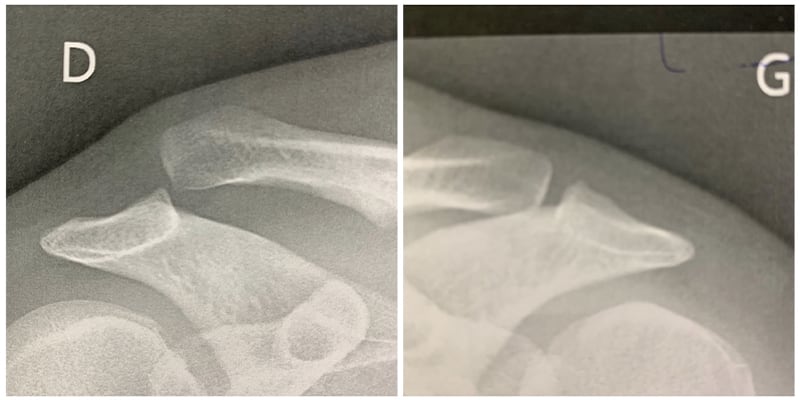 disjonction acromio claviculaire stade 1 radiographie clinique jouvenet epaule chirurgien orthopediste specialistes epaule