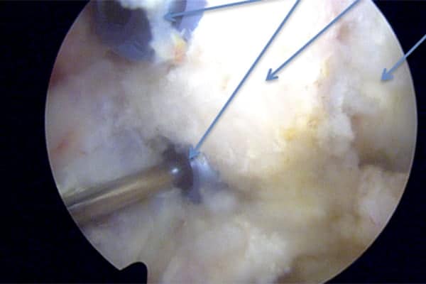 luxation posterieure epaule instabilite epaule butee coracoidienne epaule clinique jouvenet epaule chirurgien orthopediste specialistes epaule