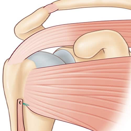 tendinopathie biceps slap epaule douleur biceps clinique jouvenet epaule chirurgien orthopediste specialistes epaule