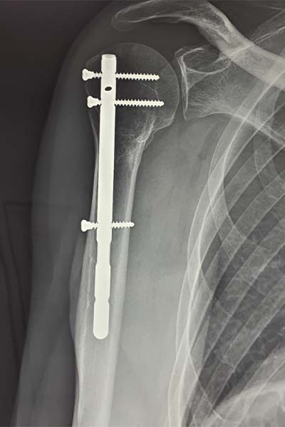 enclouage humerus pour fracture clou humeralclinique jouvenet epaule chirurgien orthopediste paris specialistes epaule paris