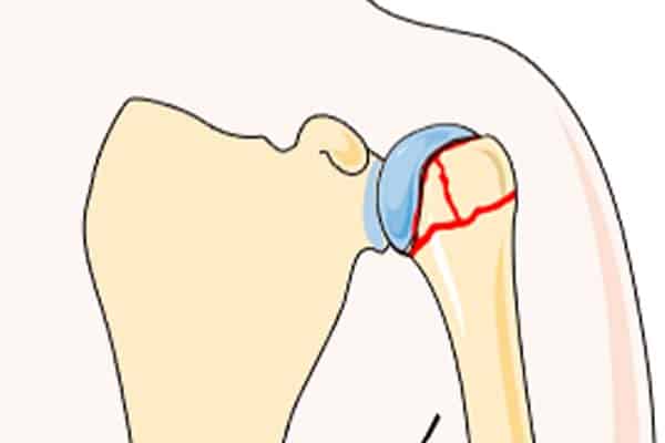 fracture neer non deplacee fracture epaule cassee classificationclinique jouvenet epaule chirurgien orthopediste paris specialistes epaule paris