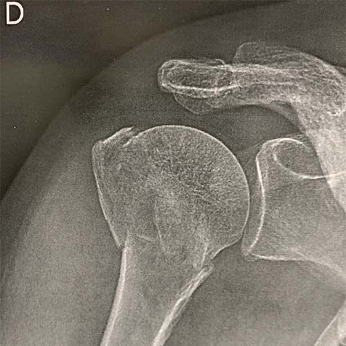 fracture peu deplacee epaule fracture humerus temps guerison epaule fractureeclinique jouvenet epaule chirurgien orthopediste paris specialistes epaule paris
