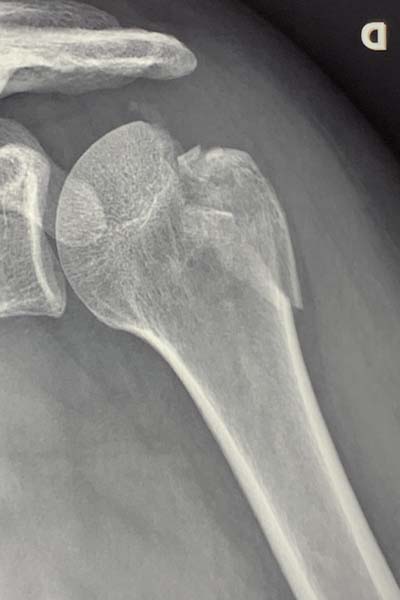 SOLUTION: Fracture de l extremit sup des 2 os de l avant bras
