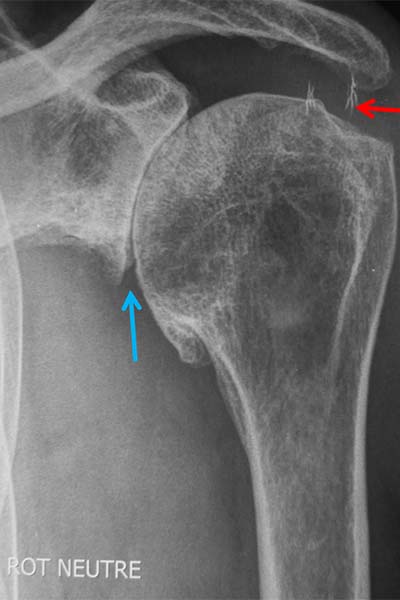 omarthrose centree traitement type d arthrose epaule radiographie clinique jouvenet epaule chirurgien orthopediste paris specialistes epaule paris