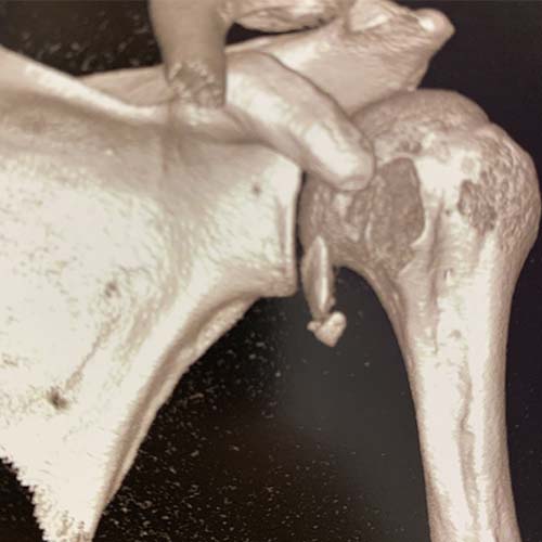 scanner epaule avec sequences 3d fracture trochin humerus epaule trochiter epauleclinique jouvenet epaule chirurgien orthopediste paris specialistes epaule paris