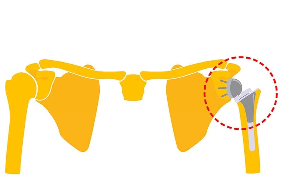 Prothèse d’épaule inversée ou anatomique : quelles différences ?
